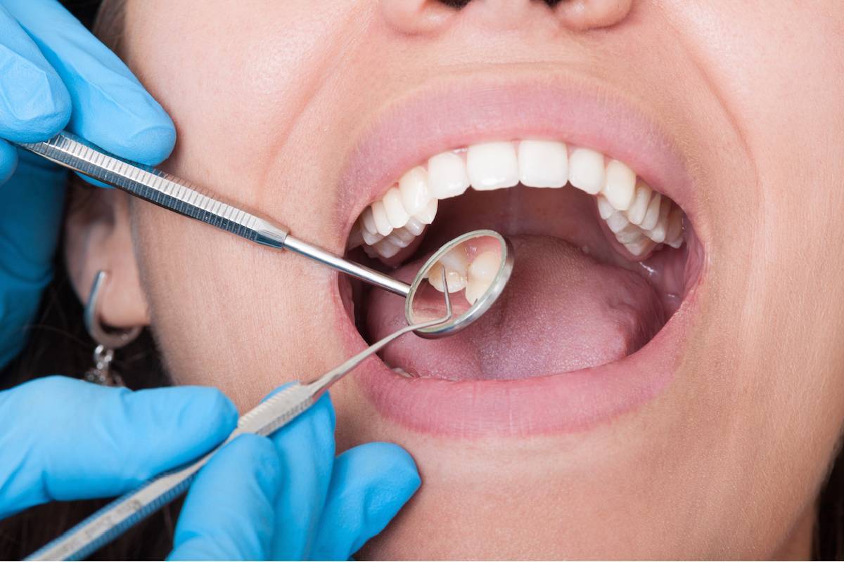 10 Must-See Ways To Easily Get Dental Implants_7