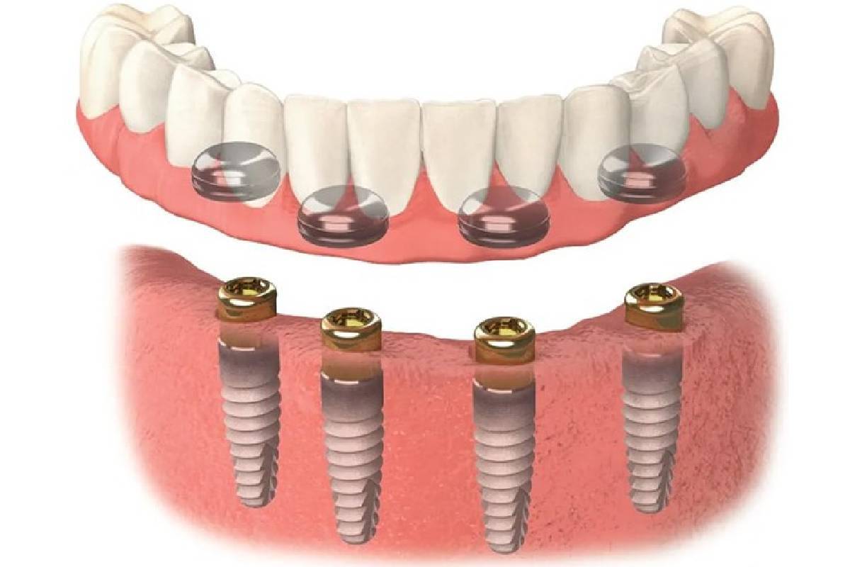 4 Affordable Dental Implant Solutions_2