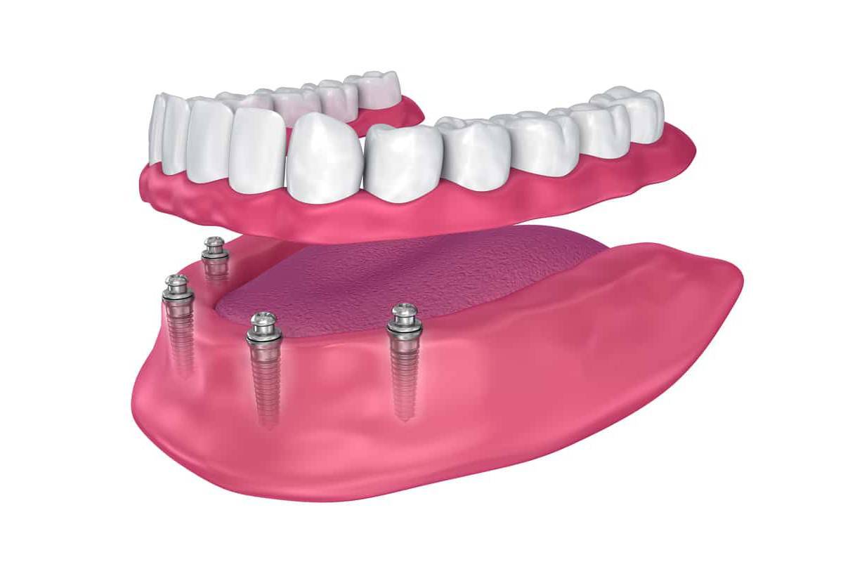 4 Affordable Dental Implant Solutions_4