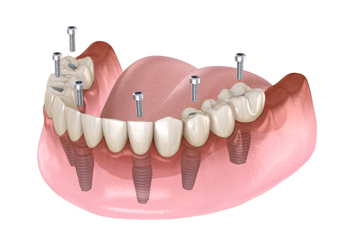 4 Affordable Dental Implant Solutions_5