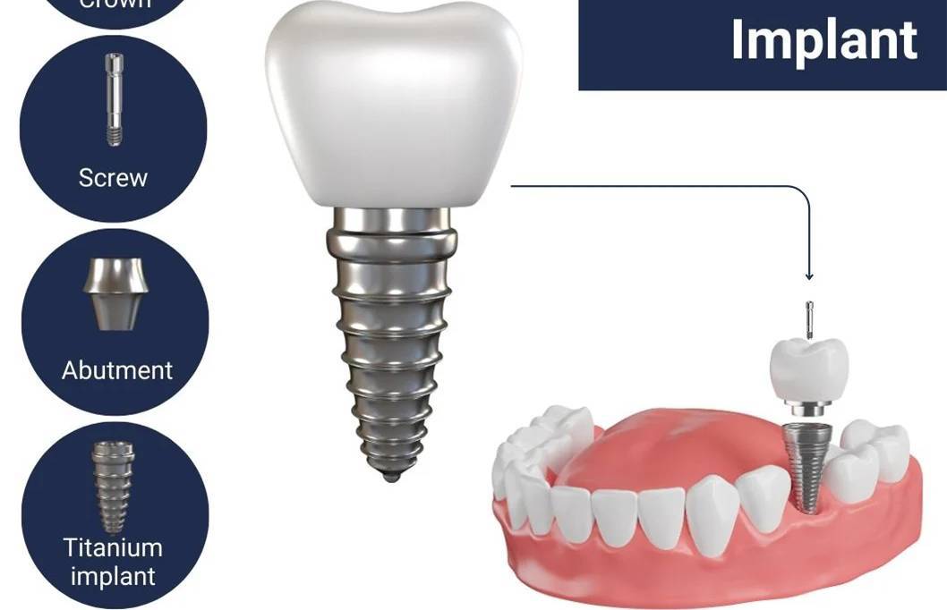 All-On-4 Implants Made Easy_5