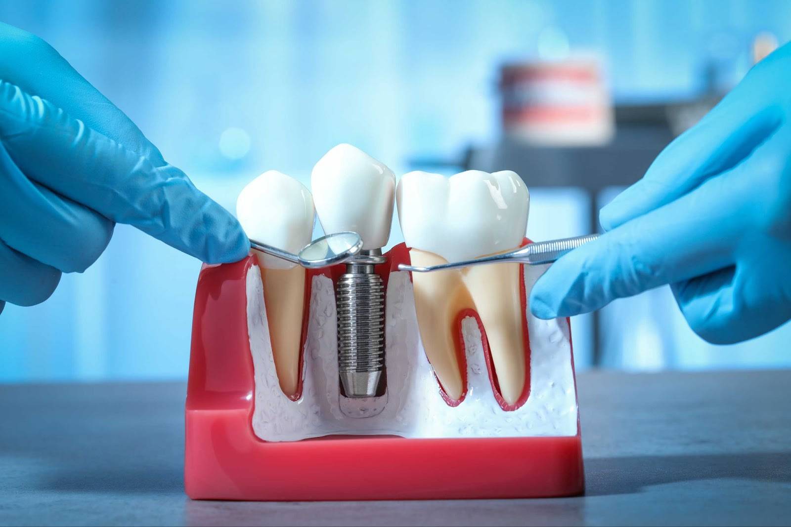 Dental Implant vs Bridge: Which Is Better For You?_2