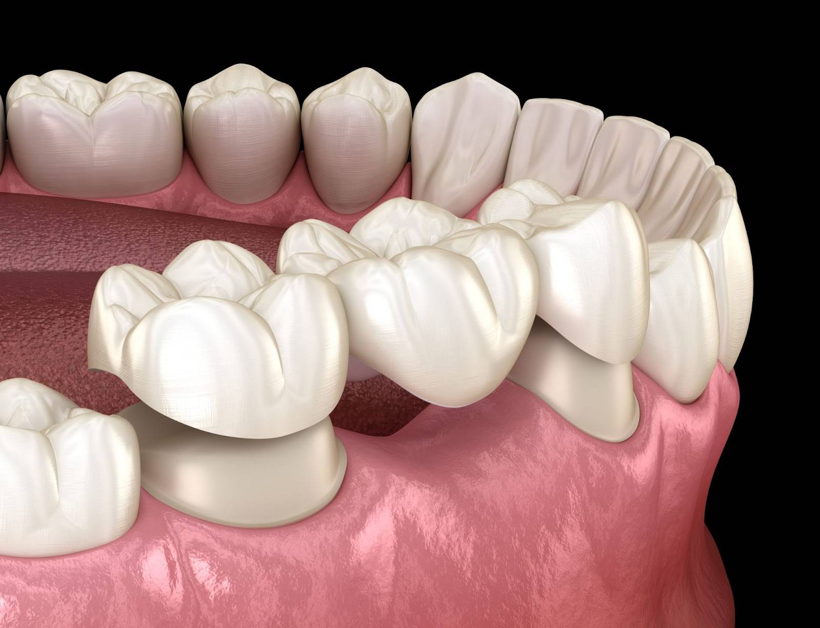 Dental Implant vs Bridge: Which Is Better For You?_4