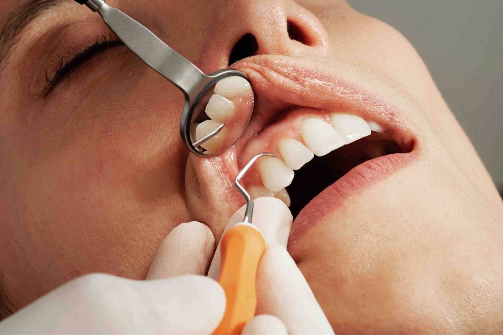 How To Get All-On-4 Dental Implants Step By Step?_4