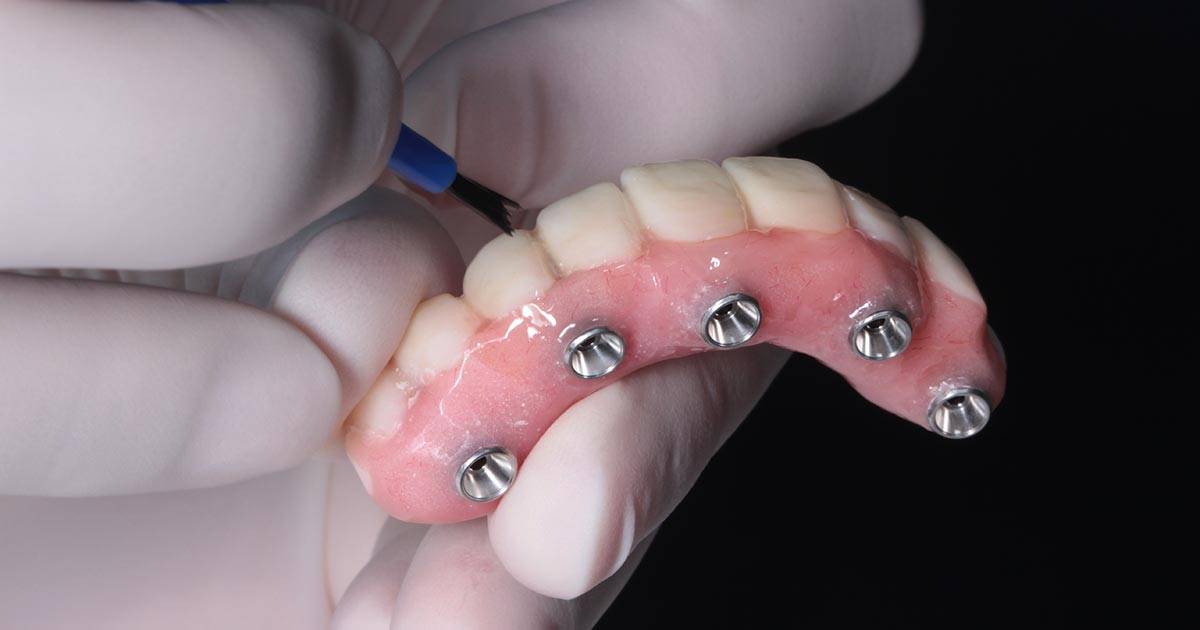 How To Get All-On-4 Dental Implants Step By Step?_5
